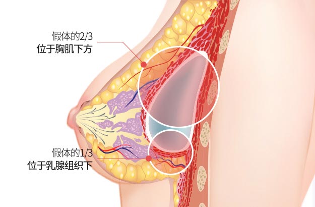 假体的2/3 位于胸肌下方 , 假体的1/3 位于乳腺组织下