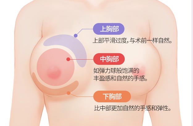 上胸部 上部平滑过度，与术前一样自然。, 中胸部 如弹力球般饱满的 丰盈感和自然的手感。, 下胸部 比中部更加自然的手感和弹性。