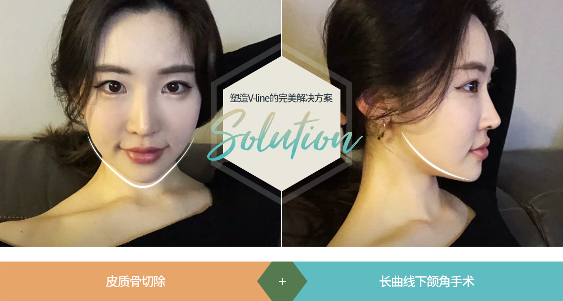 塑造V-line的完美解决方案 solution 皮质骨切除 + 长曲线下颌角手术