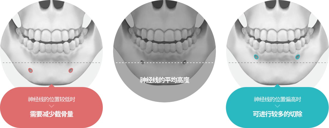 神经线的位置较低时 需要减少截骨量 , 神经线的平均高度 , 神经线的位置偏高时 可进行较多的切除 