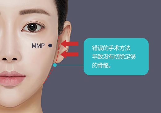 错误的手术方法 导致没有切除足够的骨骼。