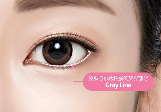 皮肤与眼睑粘膜的交界部分Gray Line