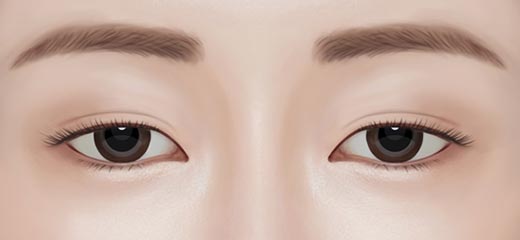 잘못된 수술방법으로 충분한 양의 뼈를 절제하지 못함