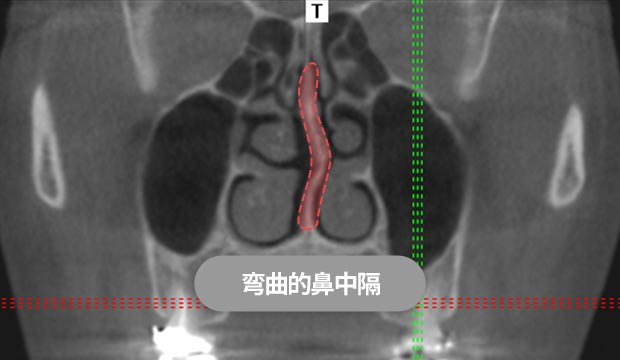 弯曲的鼻中隔