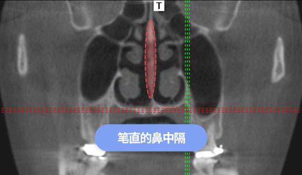 笔直的鼻中隔