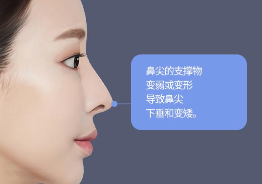 鼻尖的支撑物
								变弱或变形
								导致鼻尖
								下垂和变矮。