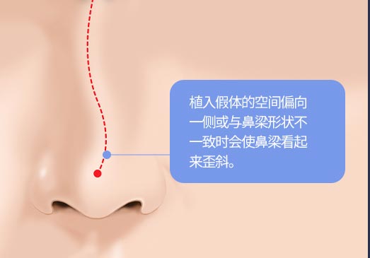 植入假体的空间偏向一侧或与鼻梁形状不一致时会使鼻梁看起来歪斜。