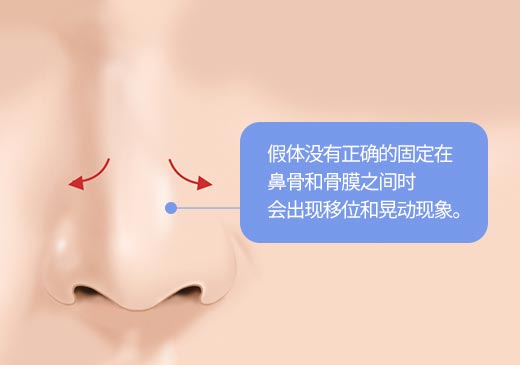 假体没有正确的固定在
								鼻骨和骨膜之间时
								会出现移位和晃动现象。
								